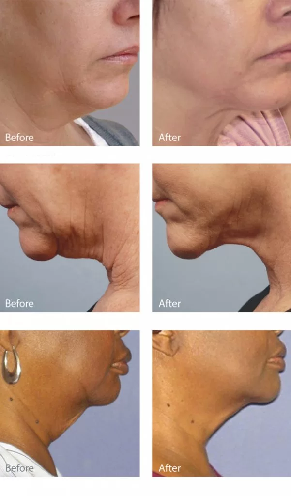 facial-skin-tightening-laval-results