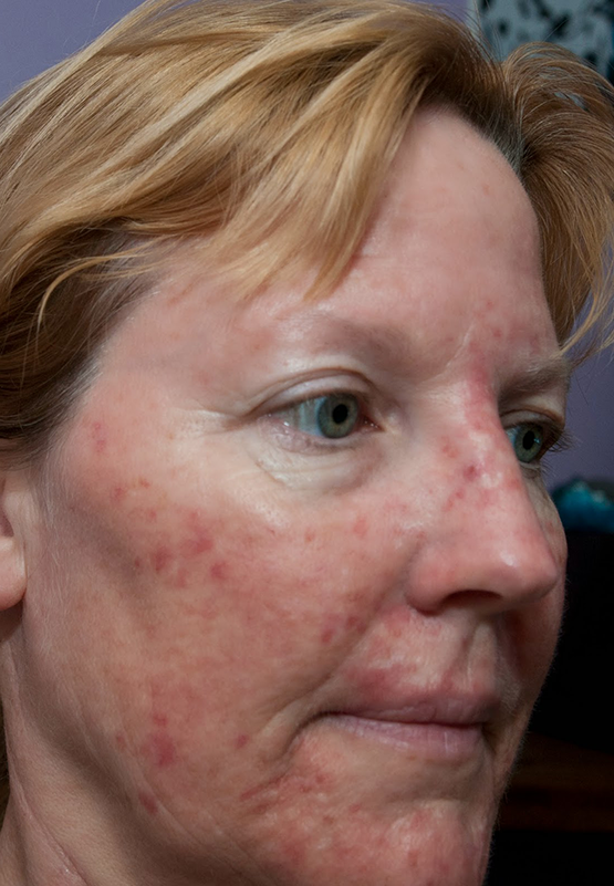 Actinic-Keratosis-treatment-near-me-laval