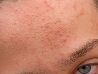 Comedones treatment laval