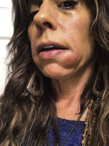 Compromised-Skin-treatment-laval