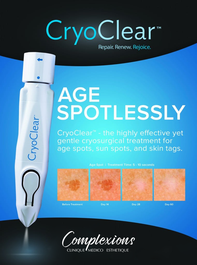 CryoClear-age-spots-sun-spots-skin-tags-laval