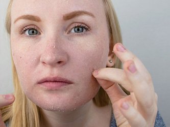 Dead Skin Cells treatment laval