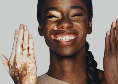 Pigmentation-Discoloration-treatment-laval-qc-near-me