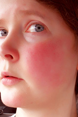 Rosacea-treatment-laval