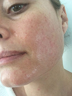 Sensitized-Skin-sensitive-skin-treatment-laval