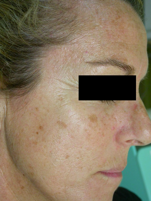 Solar-Lentigo-treatment-near-me-laval