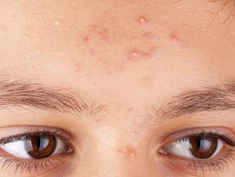 Whiteheads treatment laval