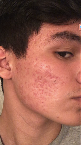 acne-scars-treatment-near-me-laval-quebec