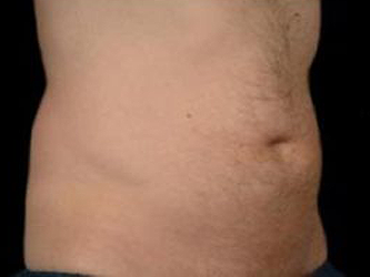adipose-tissue_excess-fat