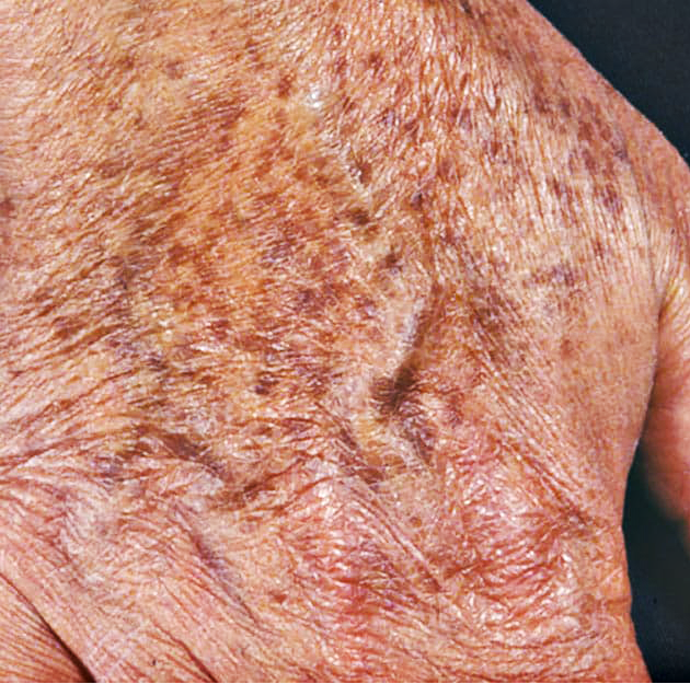 age-spots-cryotherapy-laval