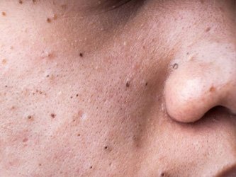 blackheads treatment laval