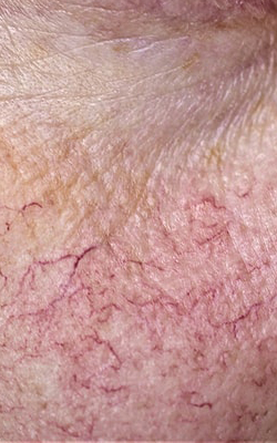 broken-capillaries-treatment-laval