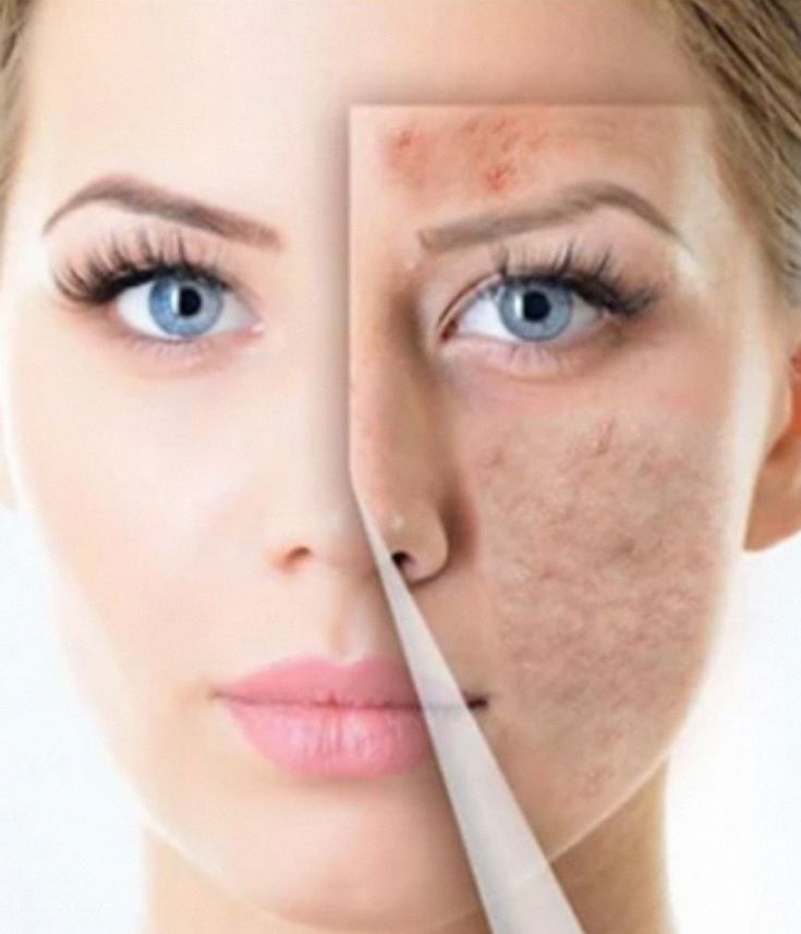 bumpy-skin-laval-clinic
