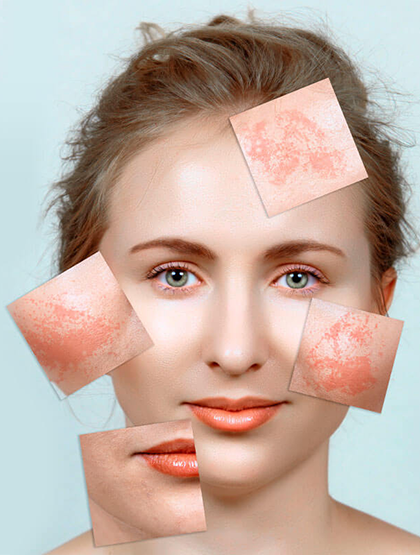 chloasma-laval-treatment