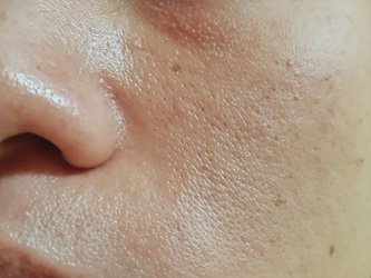 clogged congested pores treatment laval
