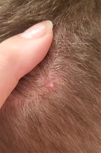 ingrown-hairs