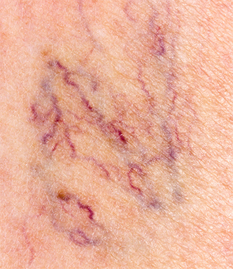 leg-veins-treatment-laval