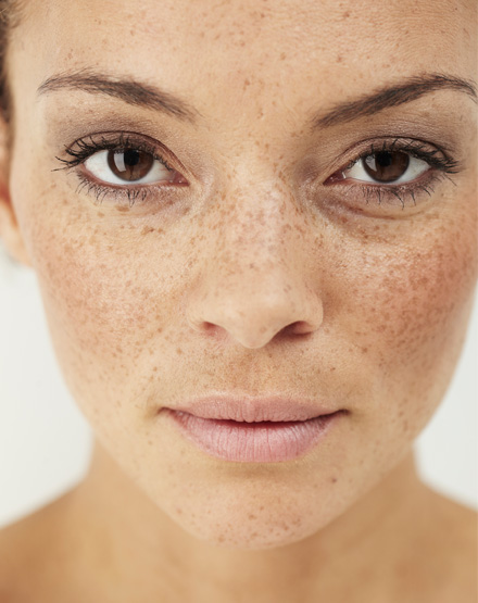 melasma treatment laval