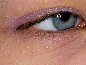 milia treatment laval
