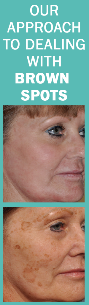 our-approach-to-brown-spots