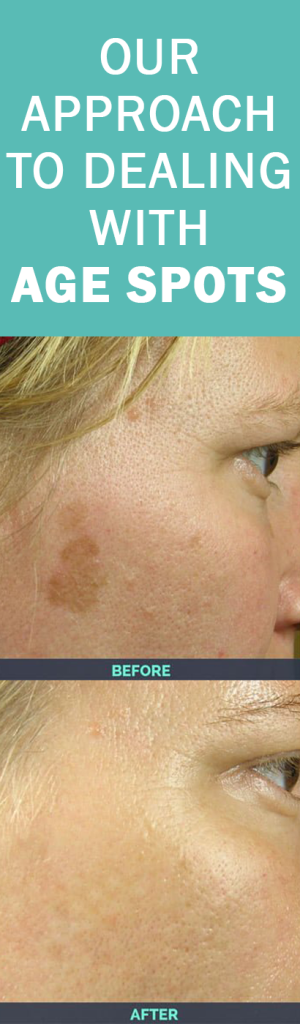 our-approach-to-dealing-with-age-spots