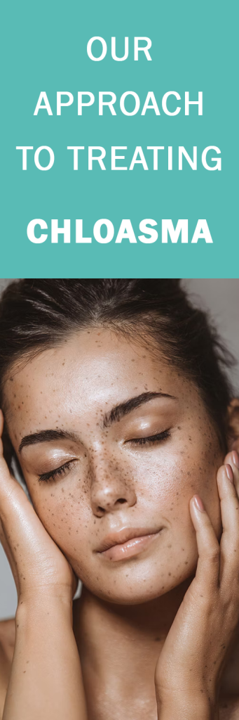 our-approach-to-treating-chloasma