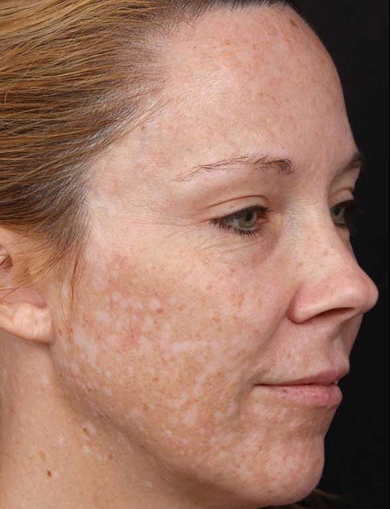 post-inflammatory-hyperpigmentation-treatment-laval