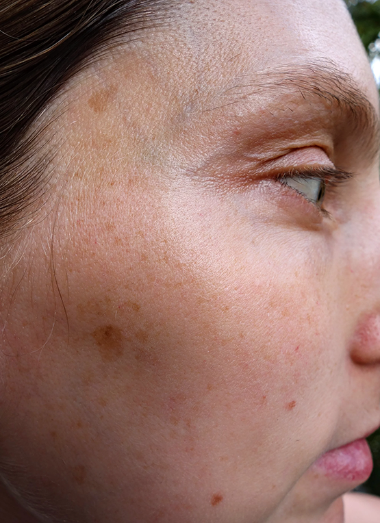pregnancy-mask-treatment-laval_02