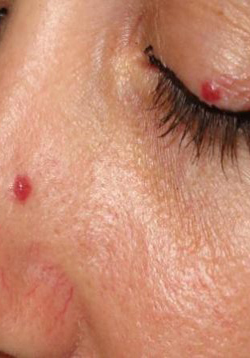 ruby-cherry-angioma-treatment-laval