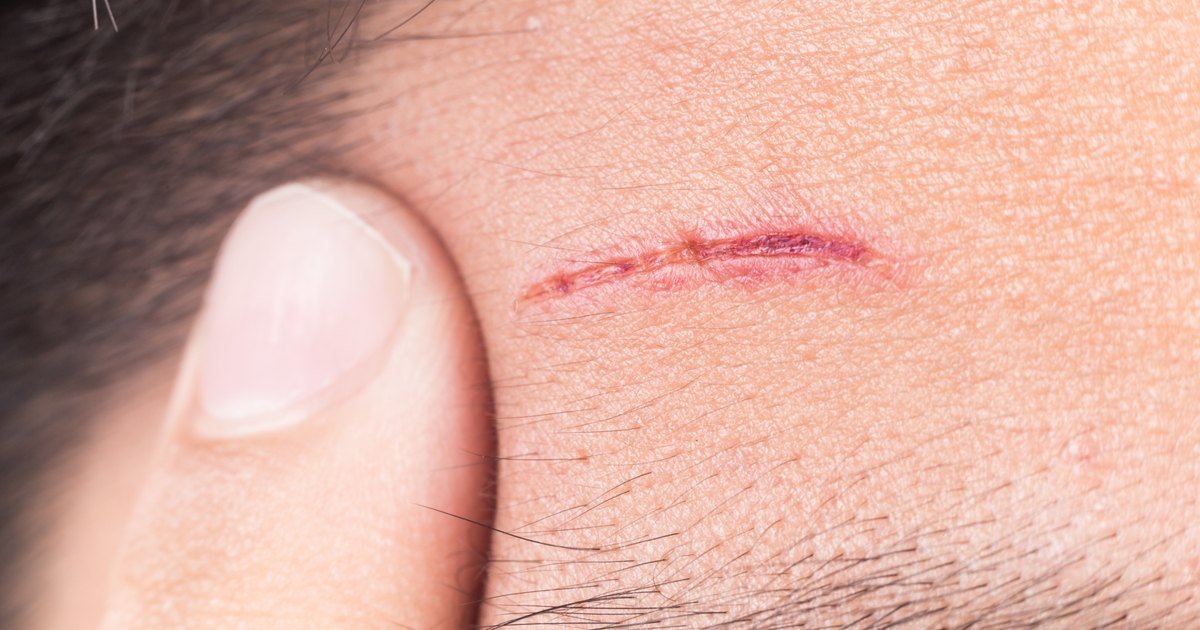 scar-treatment-near-me-laval-quebec-canada