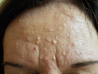 sebaceous hyperplasia treatment laval