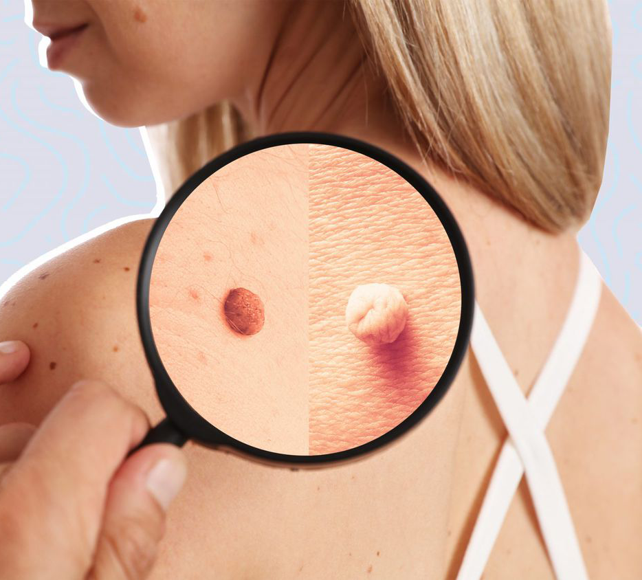 skin-tags-laval