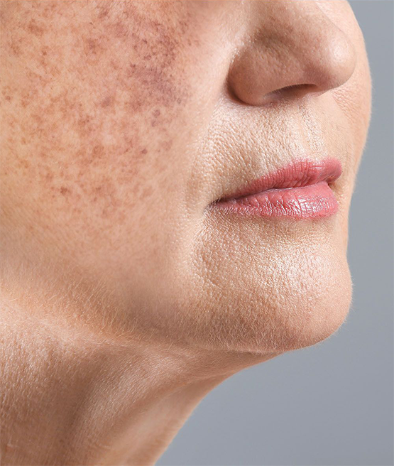 sun spots treatment laval quebec
