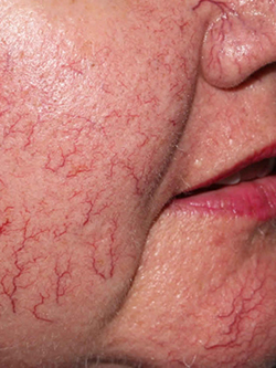 telangiectasia-treatment-laval