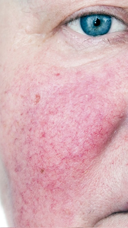 telangiectatic-rosacea-treatment-laval