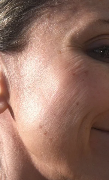 thin-skin-treatment-laval
