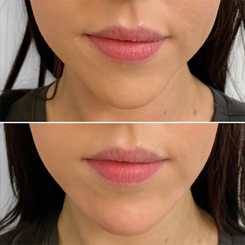 Jawline-contouring-treatment-laval
