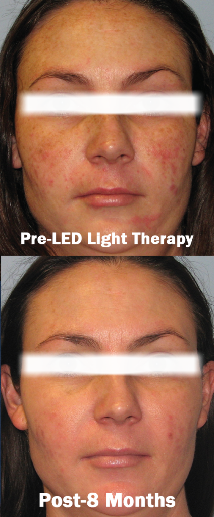 LED Light Therapy Laval results before and after