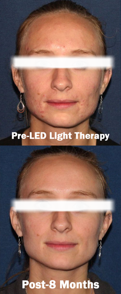 LED Light Therapy Laval results before and after