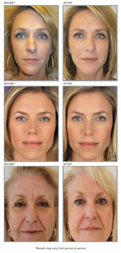 Professional-Skin-Care-Consulting-before-after