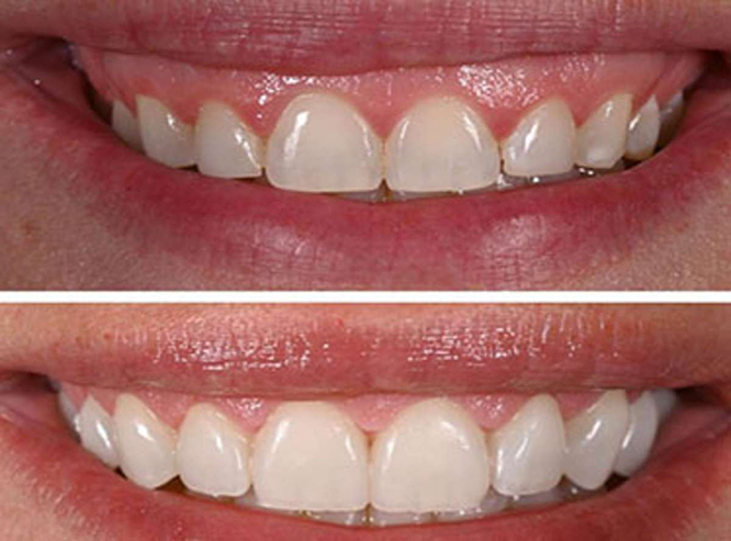 gummy-smile-treatment-laval