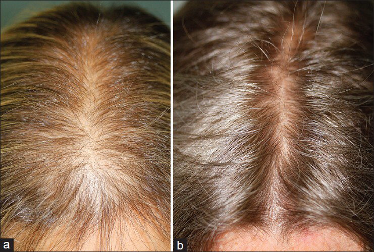 hair-restoration-treatment-laval