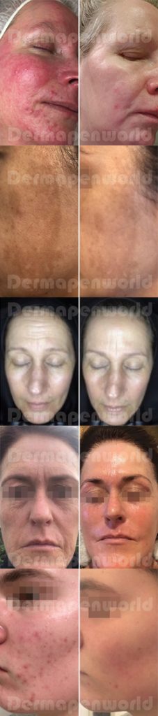 microneedling-treatment-before-after