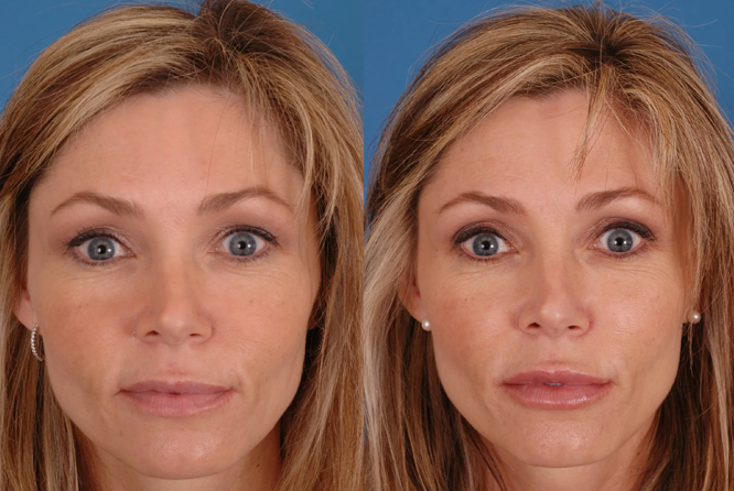 InjectableTreatments-laval