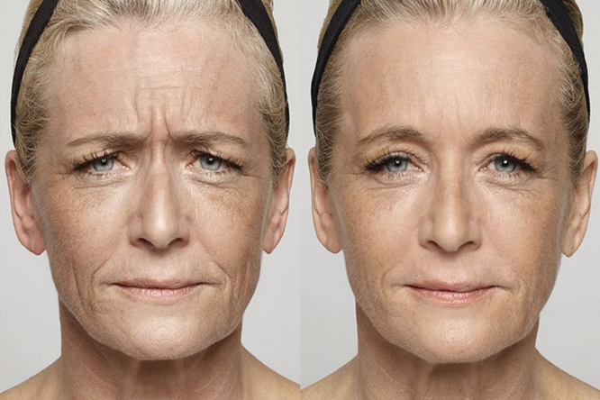 Smoothing-Wrinkles-treatment-laval
