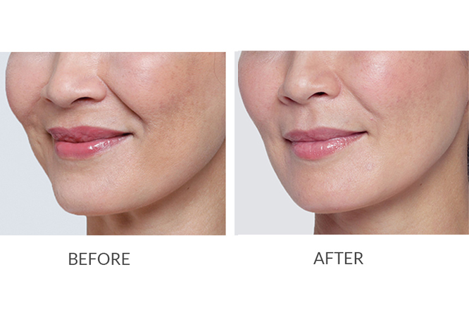 Volume-Enhancement-treatment-laval