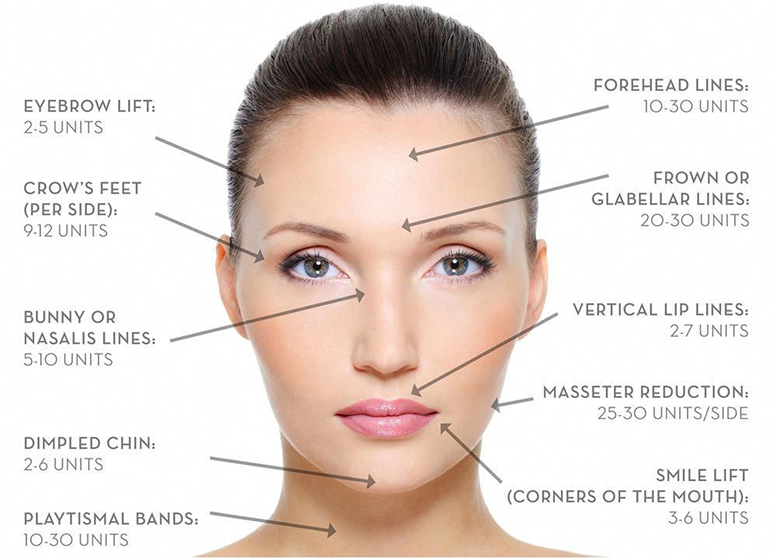 botox treatment laval by Clinique Medico Esthetique Complexion