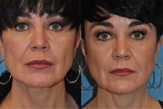 injectable-treatments-laval