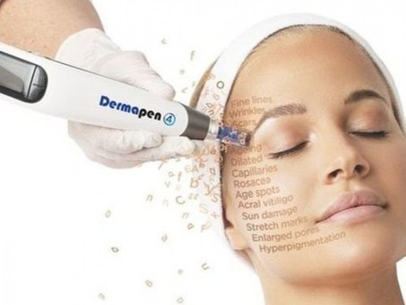 Microneedling Laval by Clinique Medico Esthetique Complexions
