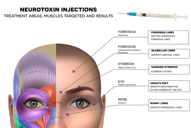 neurotoxin-injection-spots